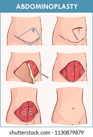 Abdominoplasty and Lipectomy Procedures