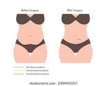 Abdominoplasty tummy tuck surgery. skin fat loss