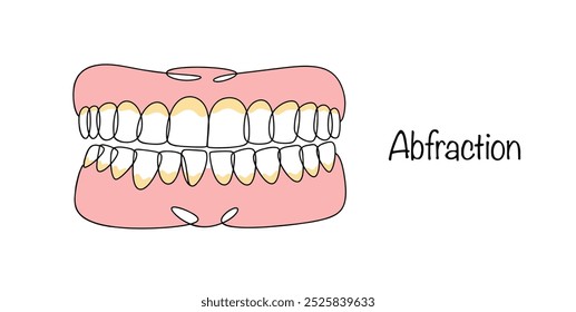 Abstracción. Una lesión que se localiza en la parte externa del diente cerca de la línea de la encía. Daño dental dibujado a mano. Problema dental. Ilustración vectorial.