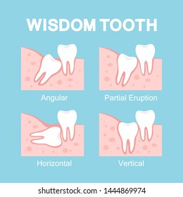 Abnormal eruption of wisdom tooth. Dental problems and toothache. Horizontal and angular eruption. Vector illustration in cartoon style