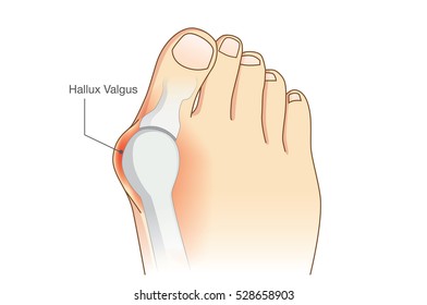 Abnormal of foot shape from deformity joint connecting the big toe. Problem of foot form wearing high heel make.