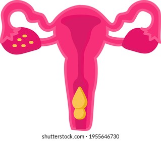 Abnormal Uterine Bleeding Concept, Extremely heavy period Vector Icon Design, In Vitro Fertilization Symbol, Pregnancy and obstetrician Sign, test tube baby procedure stock illustration