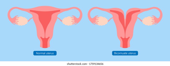 Abnormal Uterus Tipped Septum Missed Mature Cervix Double Absent Defect System Period Loss Cycle Birth Labor Short Uterus Female Treat Risk Type Exam Woman Ducts Shape