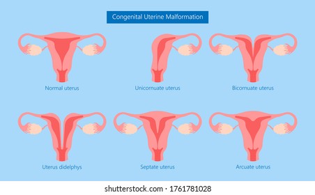 Abnormal Uterus Tipped Septum Missed Mature Cervix Double Absent Defect System Period Loss Cycle Birth Labor Short Uterus Female Treat Risk Type Exam Woman Ducts Shape