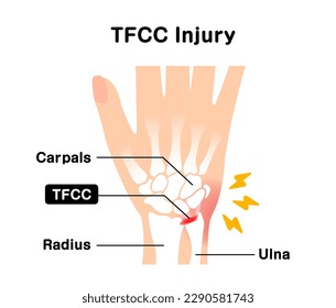 About TFCC injury. Vector illustration