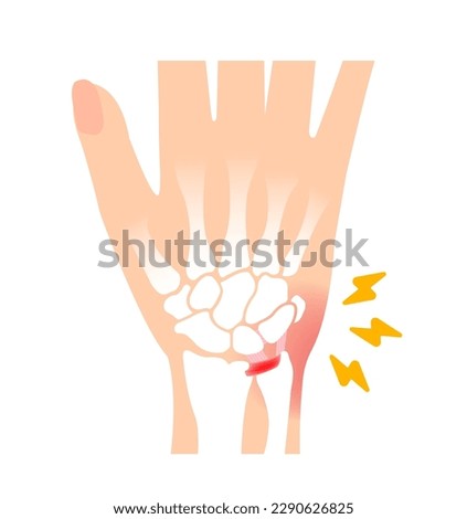About TFCC injury. Vector illustration