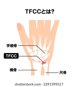 Über TFCC Vektorgrafik. Übersetzung: Was ist TFCC? , Teppiche, Radius, Ulna.