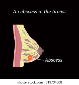 An abscess in the chest.  The structure of the breast. Mammary gland.