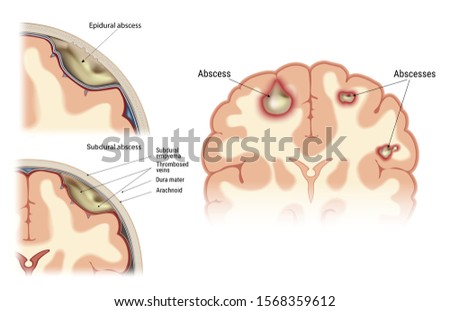 Abscess of the human brain. Visual image of the location of the focus of infectious inflammation.