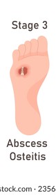 Abscess Osteitis Foot Disease Vector Illustration