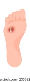 Abszess Osteitis Foot Disease Vektor Illustration