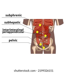 Abscesos de la cavidad abdominal. Diagrama con tipos y localización de enfermedades purulentas. Afiche médico. Ilustración del vector