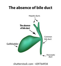 The absence of bile duct. Pathology of the gallbladder. Cholecystitis. The structure of the gallbladder. Infographics. Vector illustration on isolated background.