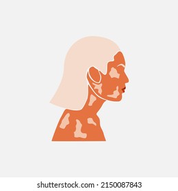 Abstract silhouette of beauty white hair woman with white pigmentation. Support awareness about chronic skin disorder. World Vitiligo day. Diversity tolerance. Fashion paper cut vector illustration
