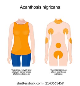 Akanthosis nigricans. Verdickte, samtige und relativ dunklere Hautflächen am Hals. Die häufigste Stelle der Akanthosis nigricans. Typ-2-Diabetes. Cushing-Syndrom. geerbtes fehlerhaftes Gen