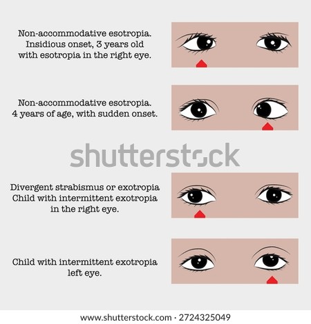Accommodative esotropia and persistent strabismus: eye diseases in children.