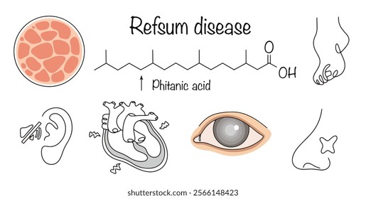 The accumulation of phytanic acid in the body leads to deafness, anosmia, cataracts, Friedreich's foot, ichthyosis, cataracts and myocarditis. Hand-drawn diagram of Refsum syndrome.