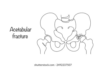 Fractura acetabular. Lesión traumática de la fosa articular de la articulación de la cadera. Ilustración vectorial dibujada a mano sobre un tema médico.