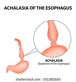 Achalasia of the esophagus. Expansion of the esophagus. Hernia. Infographics. Vector illustration on isolated background