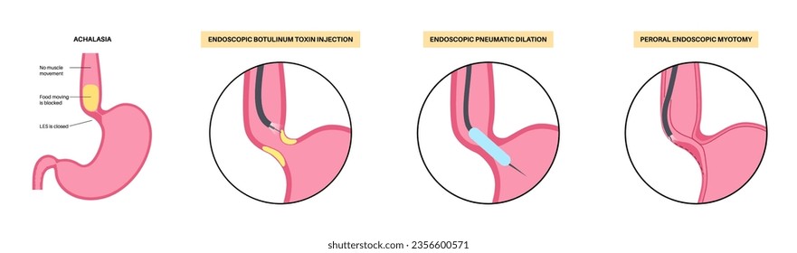 Achalasia treatments. Minimally invasive procedures. Closed lower esophageal sphincter. Endoscopic botulinum toxin injection, pneumatic dilation and POEM. Disorder of the esophagus vector illustration