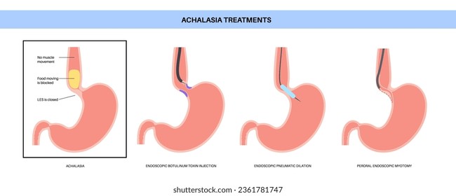 Achalasia treatments. Minimally invasive procedures. Closed lower esophageal sphincter. Endoscopic botulinum toxin injection, pneumatic dilation and POEM. Disorder of the esophagus vector illustration