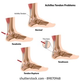 Achilles (calcaneal) tendon problems causing foot pain