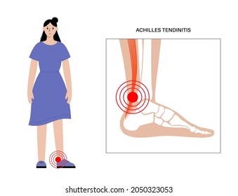 Achilles tendinitis anatomical poster. Ankle injury, ligament sprain and tear problems. Pain in the human muscular system. Tendinosis and podiatry, trauma in foot joints flat vector illustration.