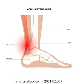 Achilles tendinitis anatomical poster. Ankle injury, ligament sprain and tear problems. Pain in the human muscular system. Tendinosis and podiatry, trauma in foot joints flat vector illustration.