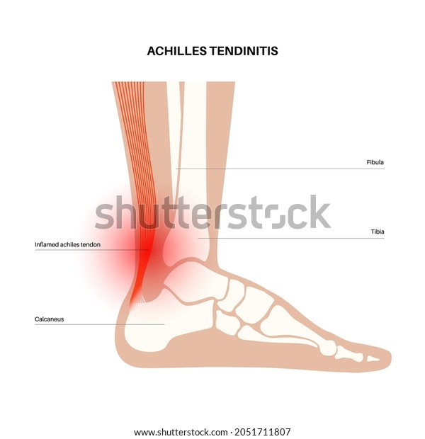Achilles tendinitis anatomical poster.\
Ankle injury, ligament sprain and tear problems. Pain in the human\
muscular system. Tendinosis and podiatry, trauma in foot joints\
flat vector\
illustration.