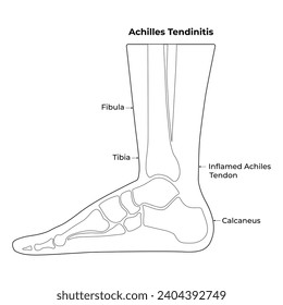 Achilles Tendinitis Science Design Vector Illustration