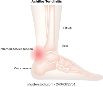 Achilles Tendinitis Science Design Vector Illustration