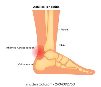 Achilles Tendinitis Science Design Vector Illustration