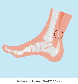 Achilles tendinopathy, human leg ,skeleton ,pain, tendon, medical tendinopathy, rupture, red, disease ,viruses ,disorder, anatomy , inflammation, foot, injury ,rotator cuff 