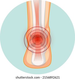 Achilles tendo rupture in circle template illustration