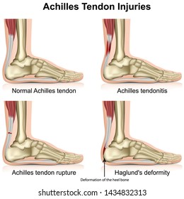 Achilles tendon injures medical vector illustration isolated on white background with english description eps 10 infographic