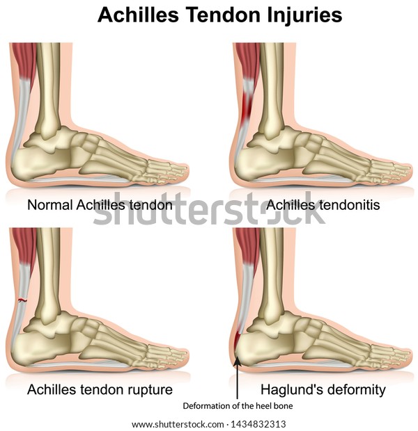 Achilles Tendon Injures Medical Vector Illustration Stock Vector Royalty Free