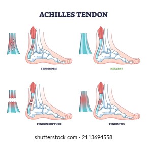 Achilles tendon injury as leg or ankle trauma outline diagram. Labeled educational inflammation and orthopedic ligament conditions vector illustration. Tendinosis, rupture and tendinitis problem.