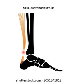 Achilles tendon rupture anatomical poster. Ankle injury, ligament sprain and tear problems. Trauma in human muscular system. Tendinosis and podiatry, pain in foot joints flat vector illustration.