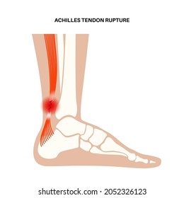 Achilles tendon rupture anatomical poster. Ankle injury, ligament sprain and tear problems. Trauma in human muscular system. Tendinosis and podiatry, pain in foot joints flat vector illustration.
