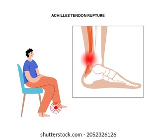 Achilles tendon rupture anatomical poster. Ankle injury, ligament sprain and tear problems. Trauma in human muscular system. Tendinosis and podiatry, pain in foot joints flat vector illustration.