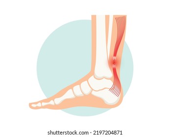 Achilles tendon rupture anatomical poster. Ankle injury, ligament sprain and tear problems