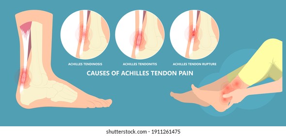 Achilles tendon rupture injury Feet calf test range of motion slight ache problem limb Thompson Simmonds