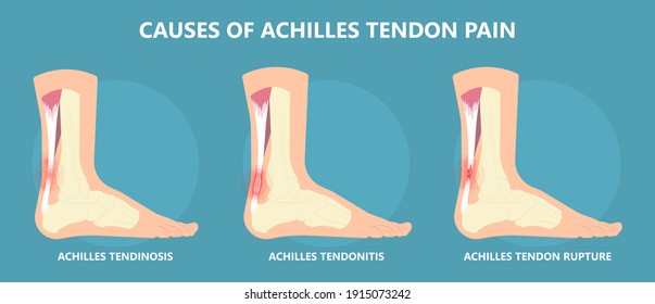 Achilles Tendon Rupture Injury Feet Calf Test Range Of Motion Slight Ache Problem Limb Thompson Simmonds