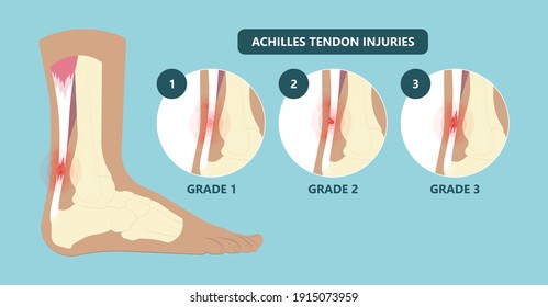 Achilles Tendon Rupture Injury Feet Calf Test Range Of Motion Slight Ache Problem Limb Thompson Simmonds