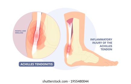 achillis tendonitis jelentése magyarul