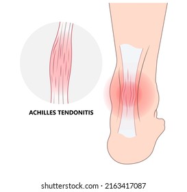 Achilles Tendon Rupture Injury Feet Calf Test Range Of Motion Slight Ache Problem Limb Thompson Simmonds