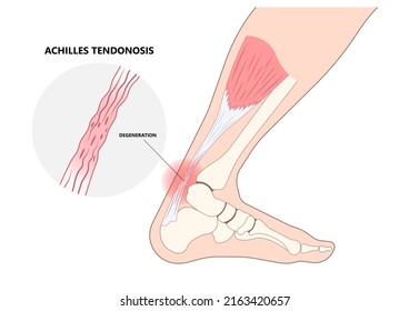 Achilles Tendon Rupture Injury Feet Calf Test Range Of Motion Slight Ache Problem Limb Thompson Simmonds