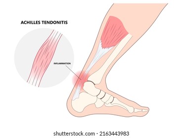 Achilles tendon rupture injury Feet calf test range of motion slight ache problem limb Thompson Simmonds