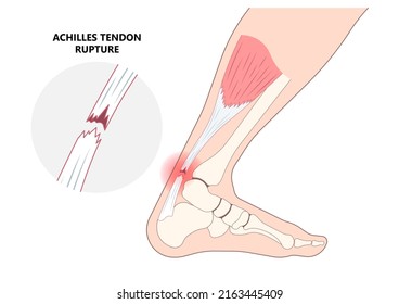 Achilles Tendon Rupture Injury Feet Calf Test Range Of Motion Slight Ache Problem Limb Thompson Simmonds