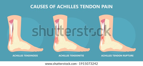 Achilles Tendon Rupture Injury Feet Calf Stock Vector (Royalty Free ...